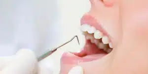 Kvinde der får renset sine tænder for tandsten