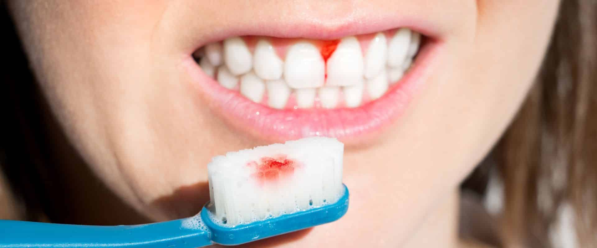 Sundt tandkød bløder ikke